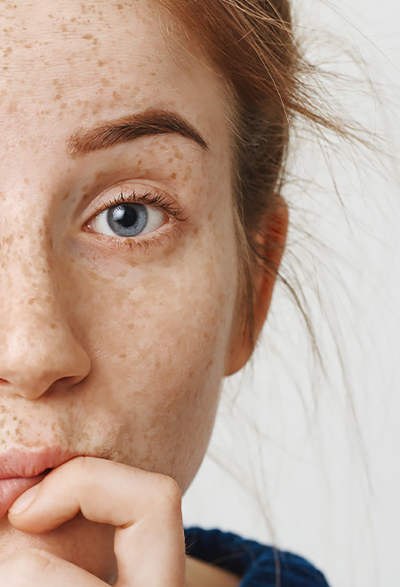 Melasma Leke Tedavisi