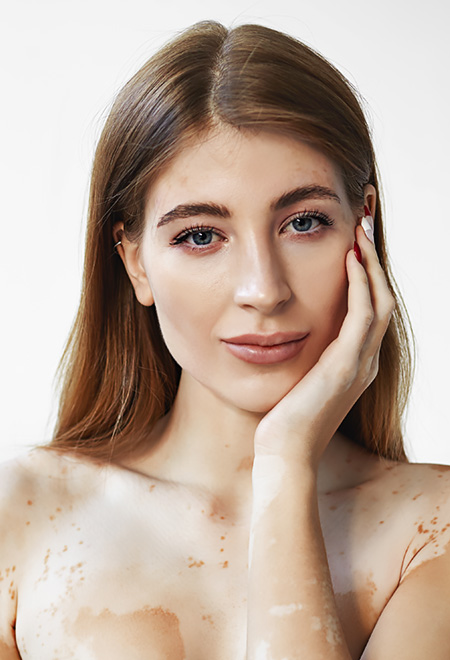 Melasma ve Leke Tedavisi Melasma ve Leke Tedavisi