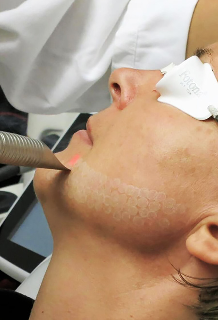 Fotona Erbium Lazer Nedir Fotona Erbium Lazer Nedir