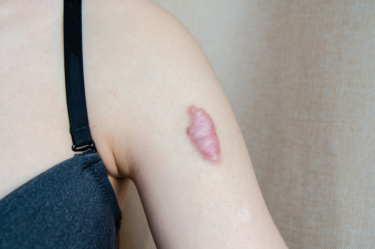 keloid-tedavisi