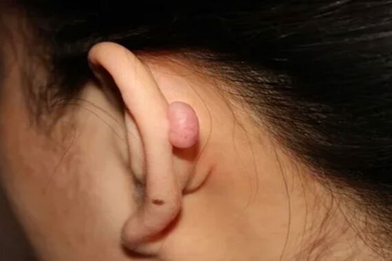 Keloid Neden Olur